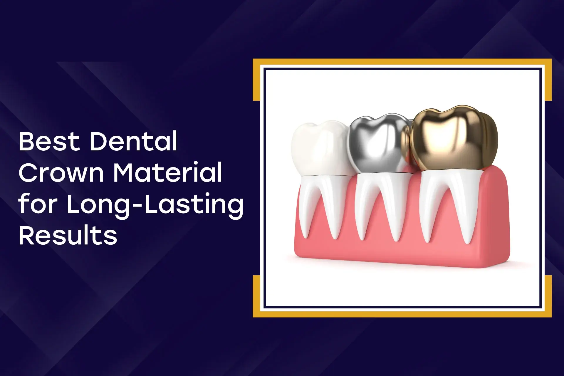 Best Dental Crown Material