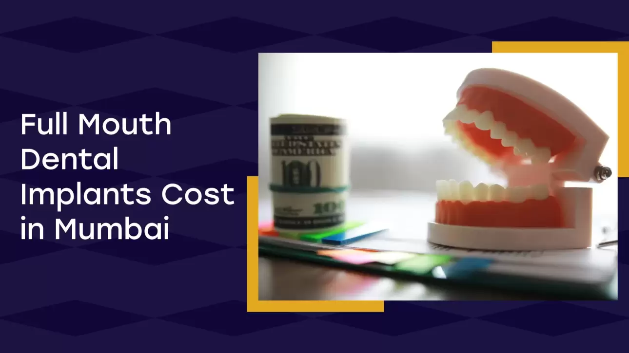Full Mouth Dental Implants Cost In Mumbai
