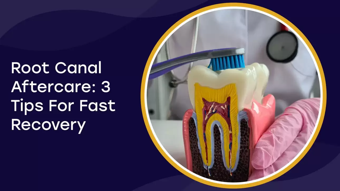 Root Canal Aftercare Tips