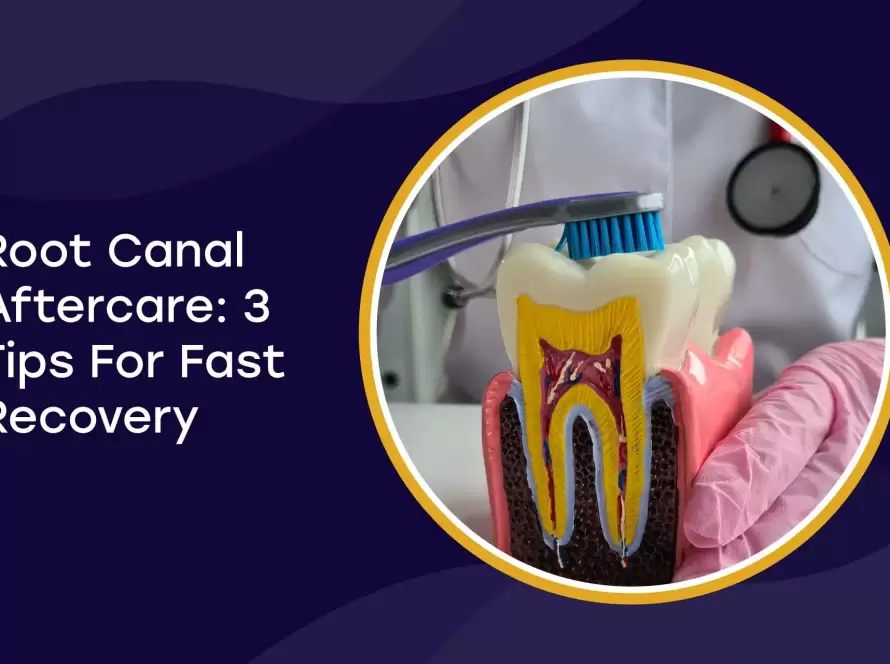 Root Canal Aftercare Tips