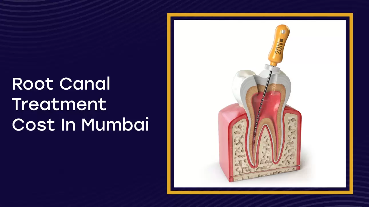 Root Canal Cost in Mumbai