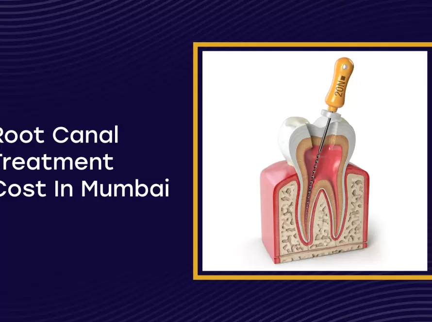 Root Canal Cost in Mumbai