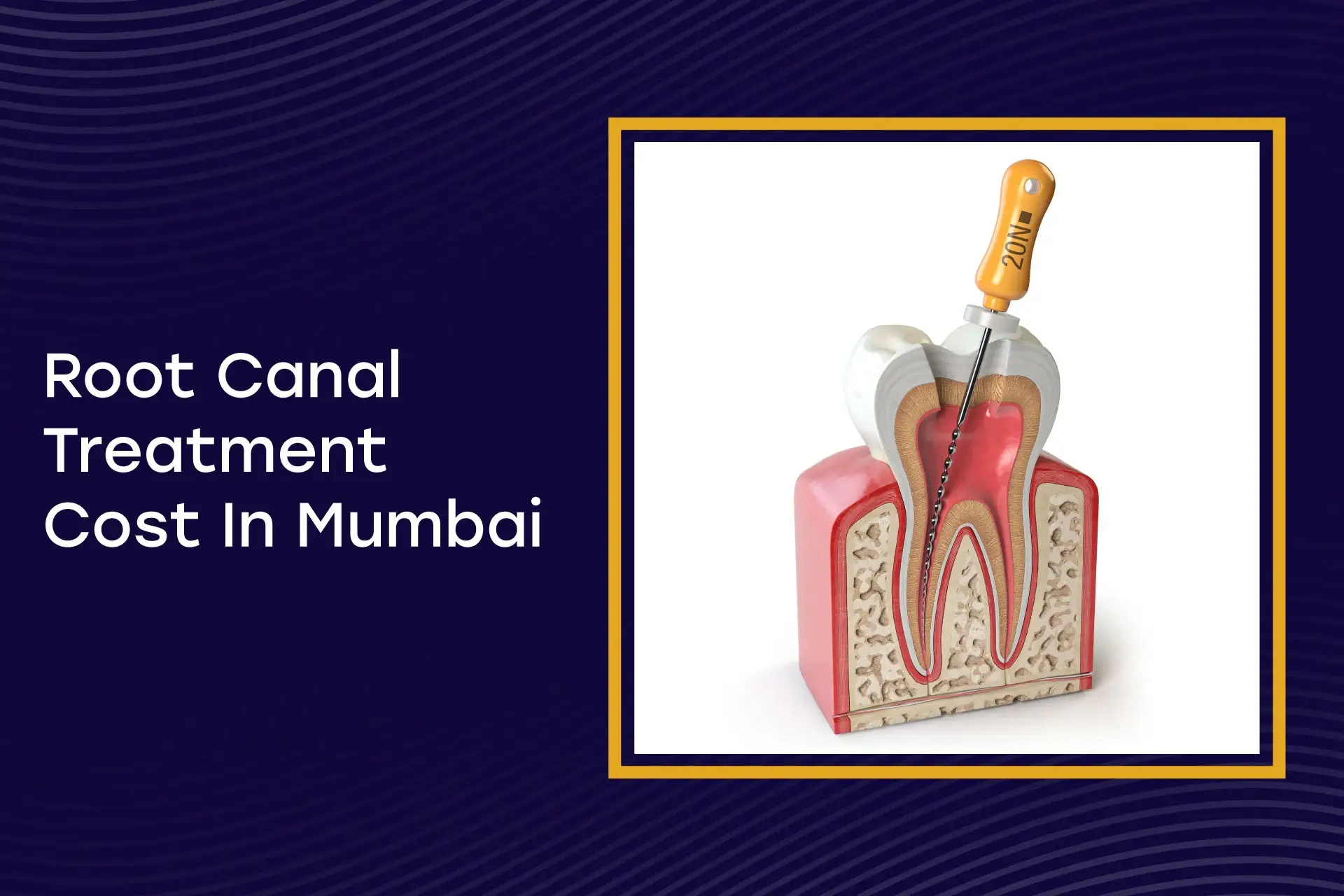 Root Canal Cost in Mumbai