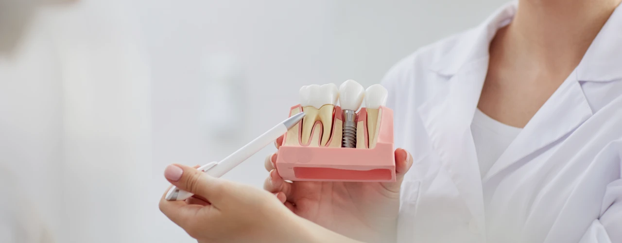 Dental Implants Treatment