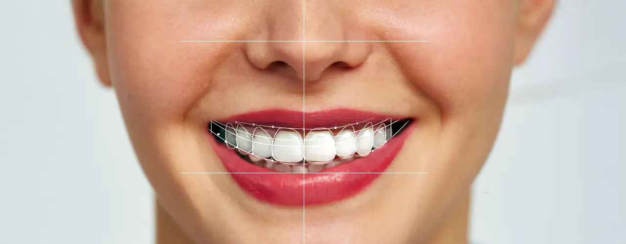 Digital Smile Design Treatment