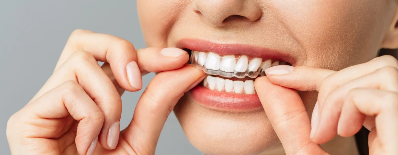 Invisalign Treatment