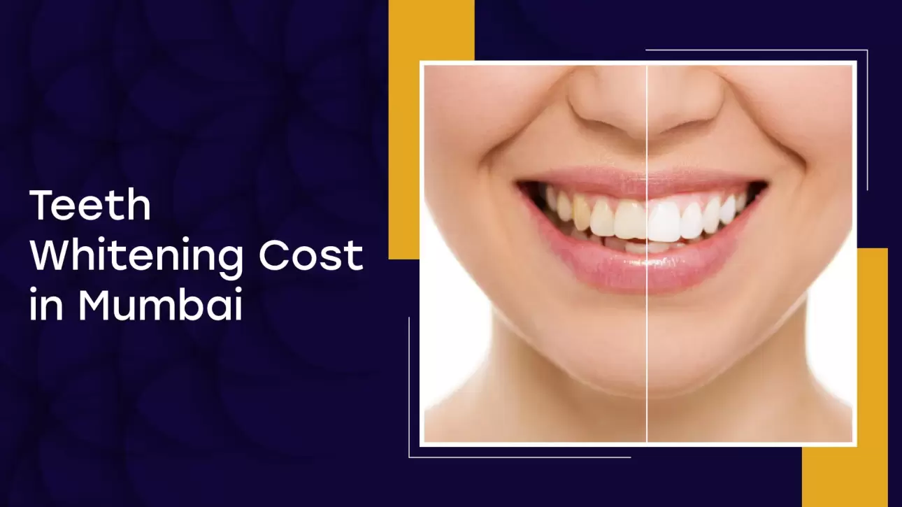 Teeth Whitening Cost In Mumbai