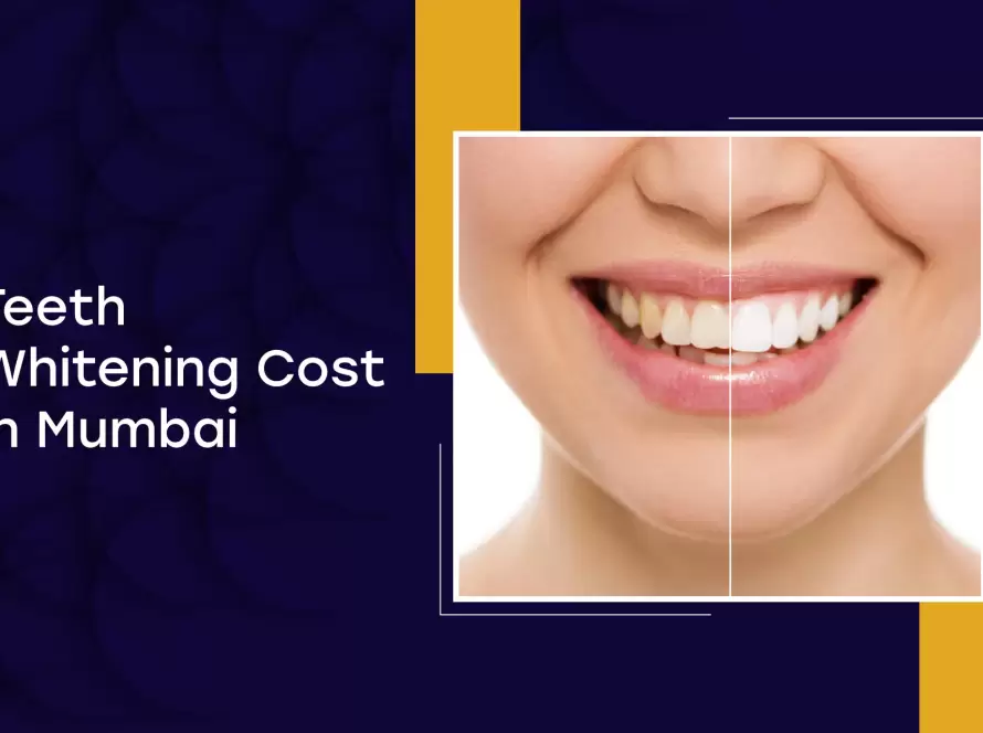 Teeth Whitening Cost In Mumbai