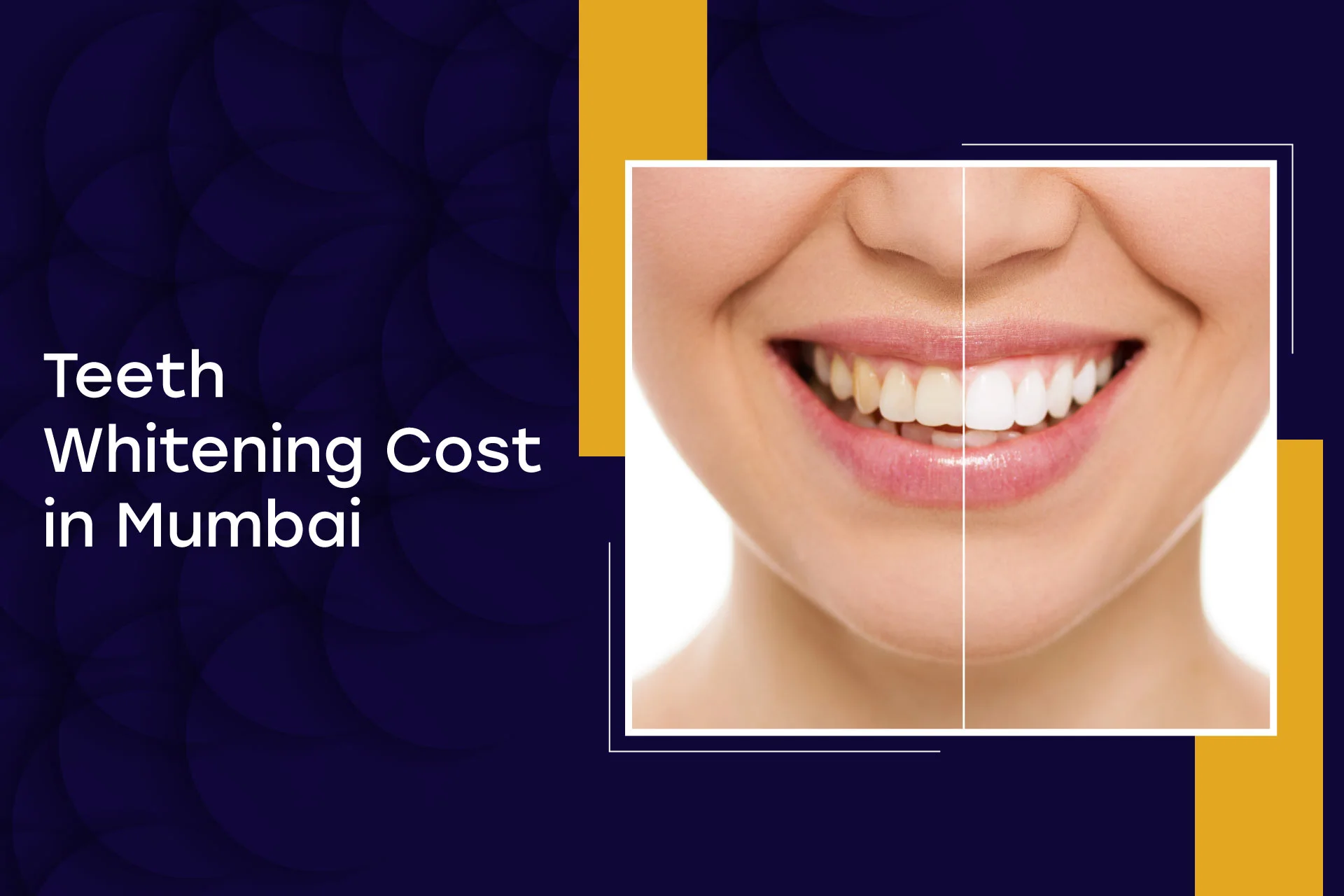 Teeth Whitening Cost In Mumbai